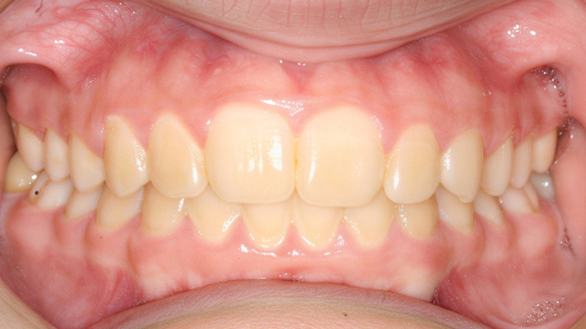 invisalign-after-2-2