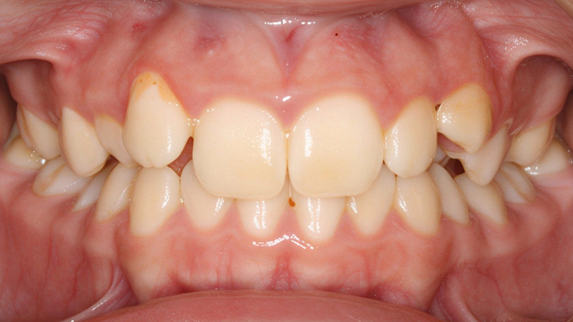 invisalign-before-2