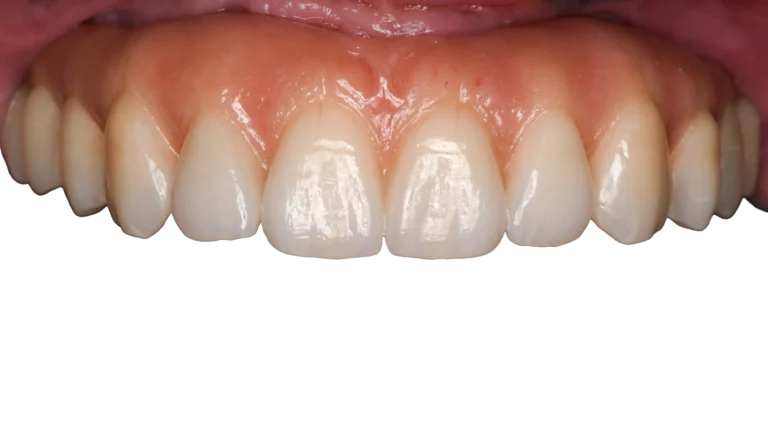 best dental implant near me