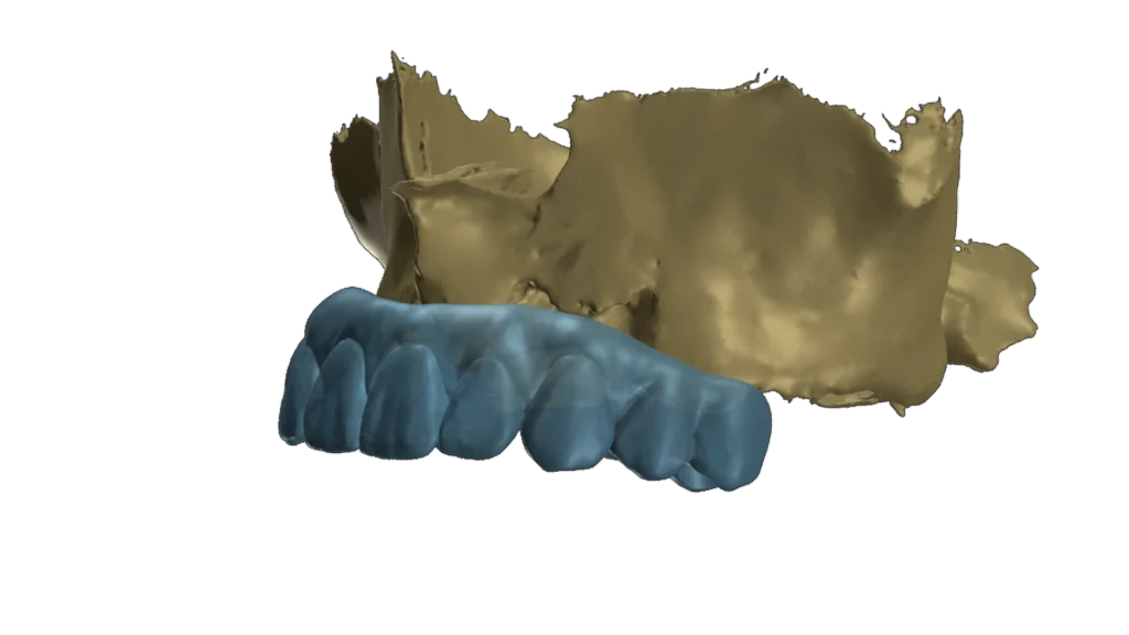 3d dental implants planning