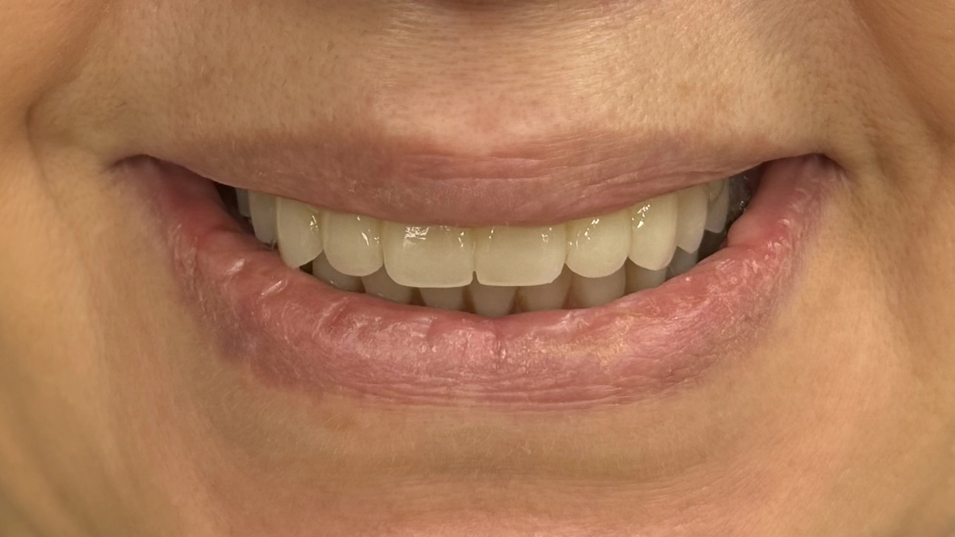 Après une restauration par implant immédiat chez VIDENT Anvers