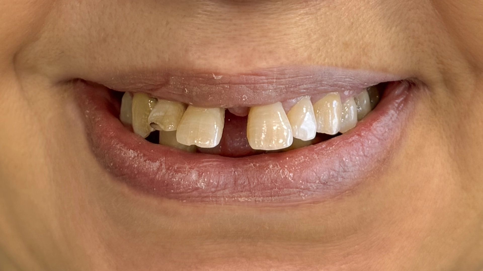 Before dental implant treatment - patient case 2 at VIDENT Antwerp