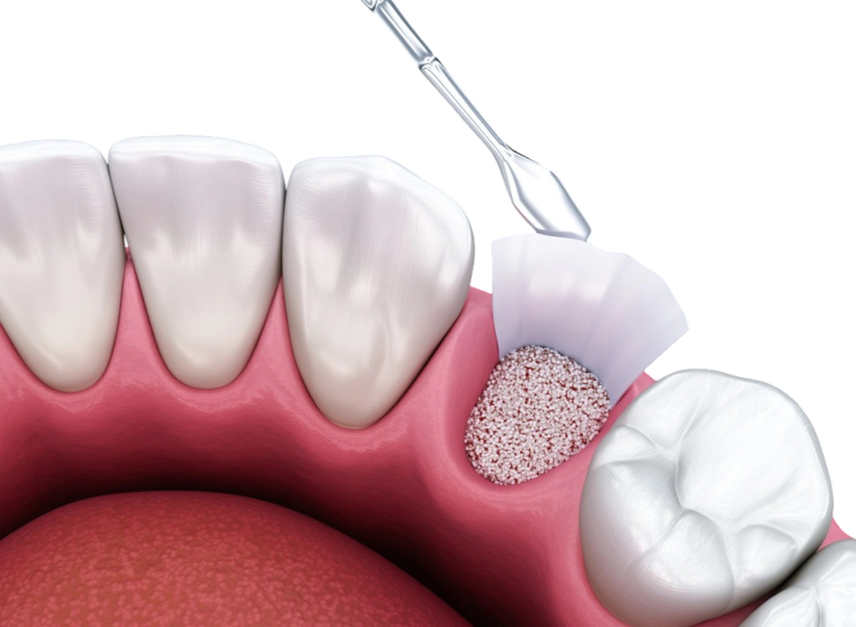 bone grafting for dental implants