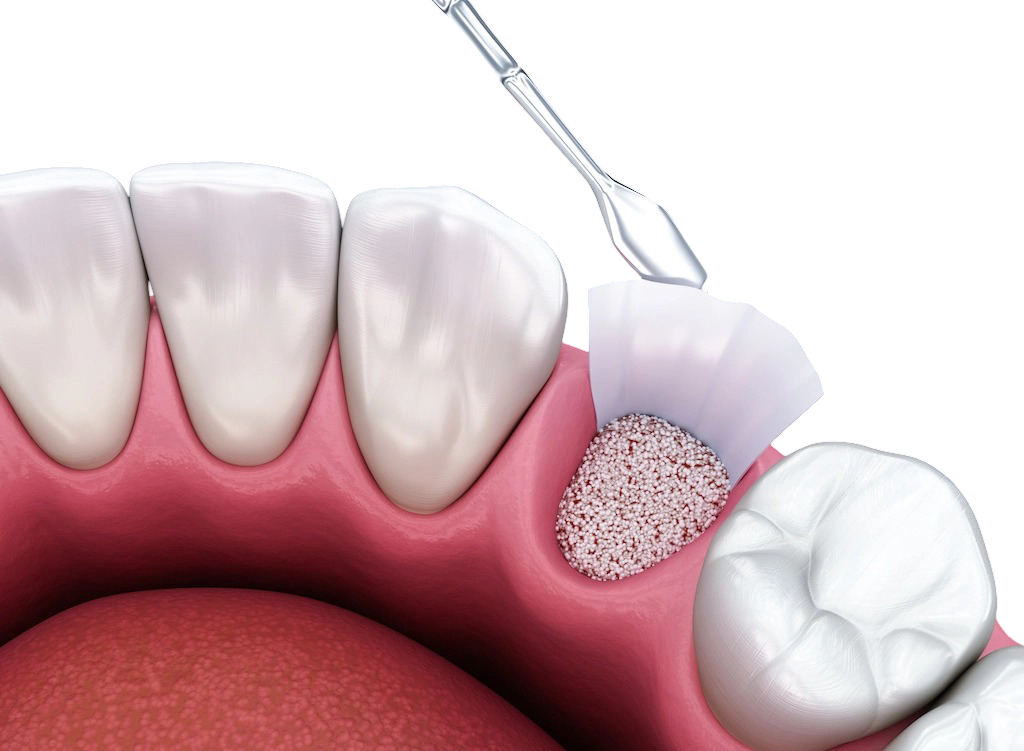 bone grafting for dental implants