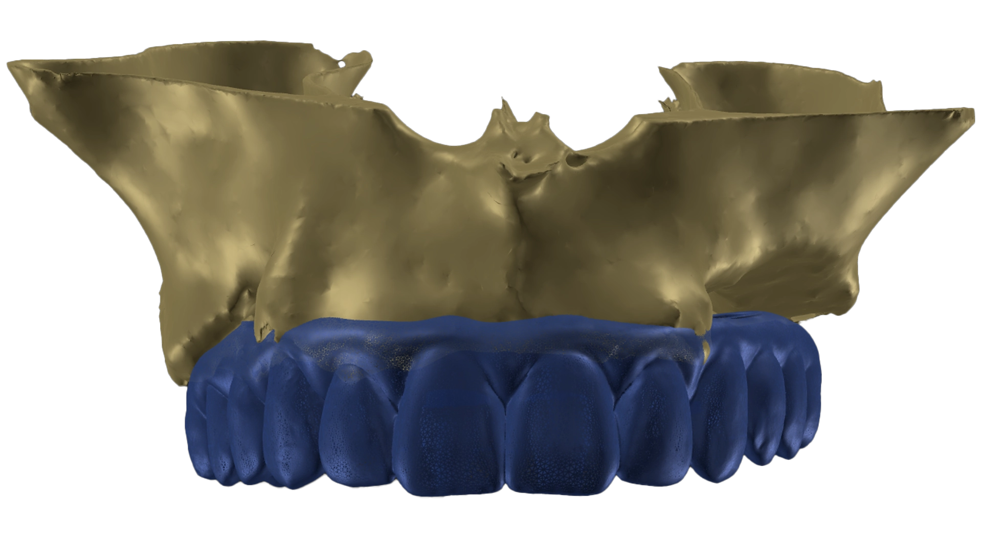 Digitale 3D-planning voor tandimplantaten vs bruggen bij VIDENT Antwerpen