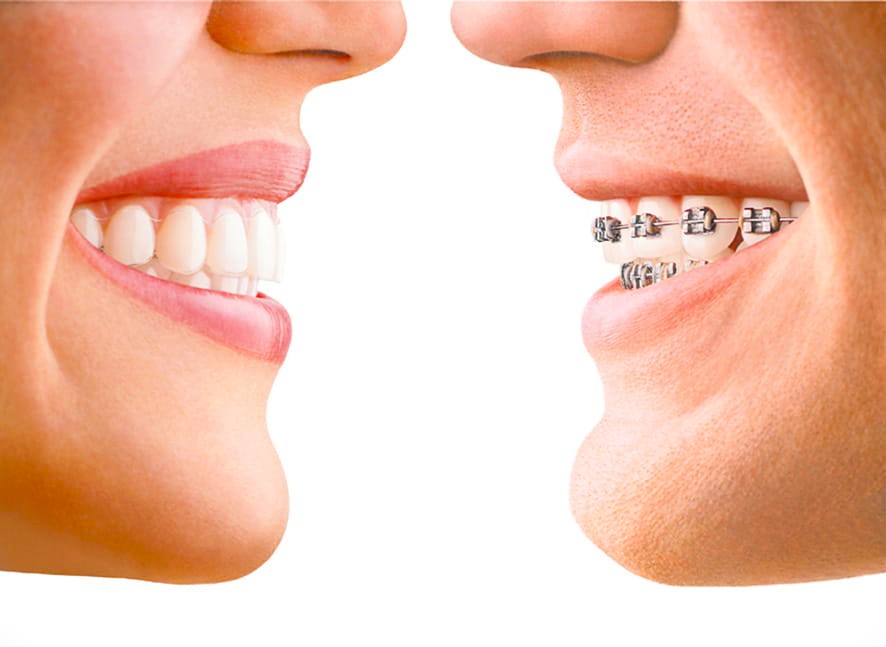 Clear aligners vs braces comparison at VIDENT Antwerp