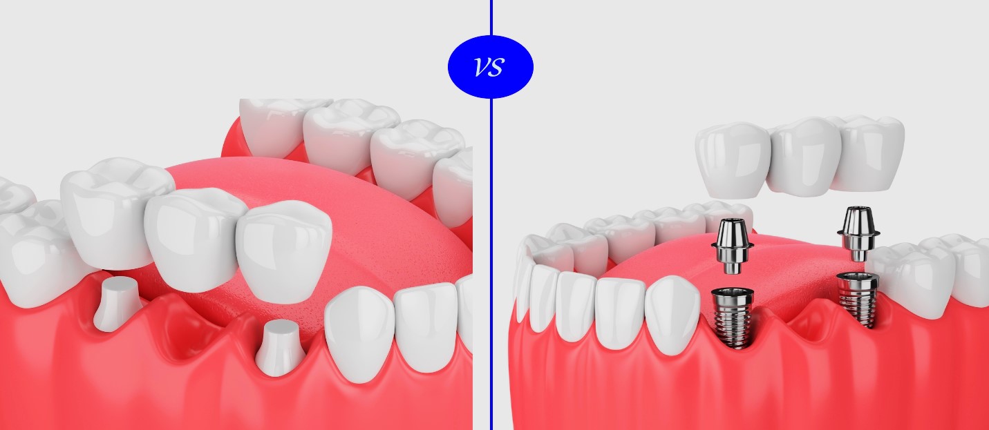 Tandimplantaten vs tandbruggen vergelijking bij VIDENT Antwerpen
