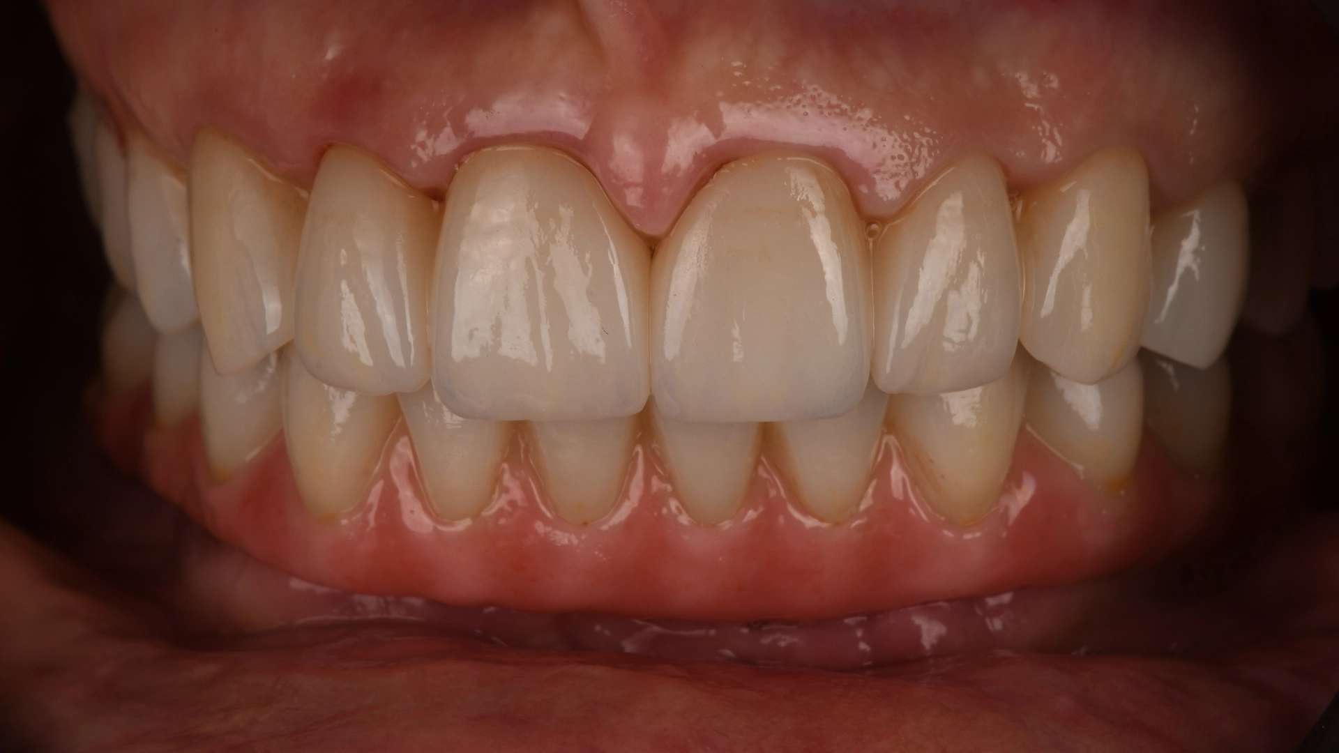 След успешна оценка и планиране на дентални импланти във VIDENT Antwerp