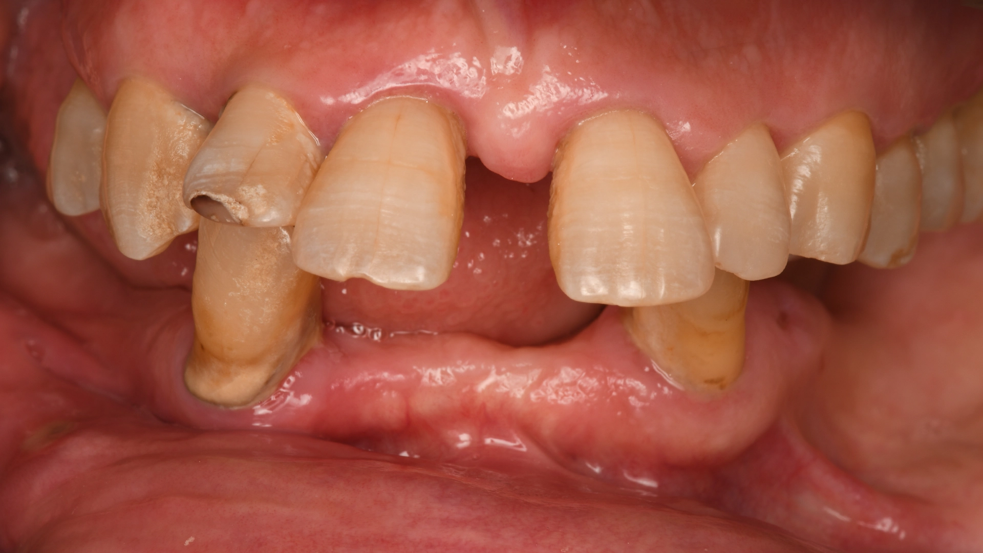 Преди оценка на пригодност за дентални импланти – пациент с противопоказания