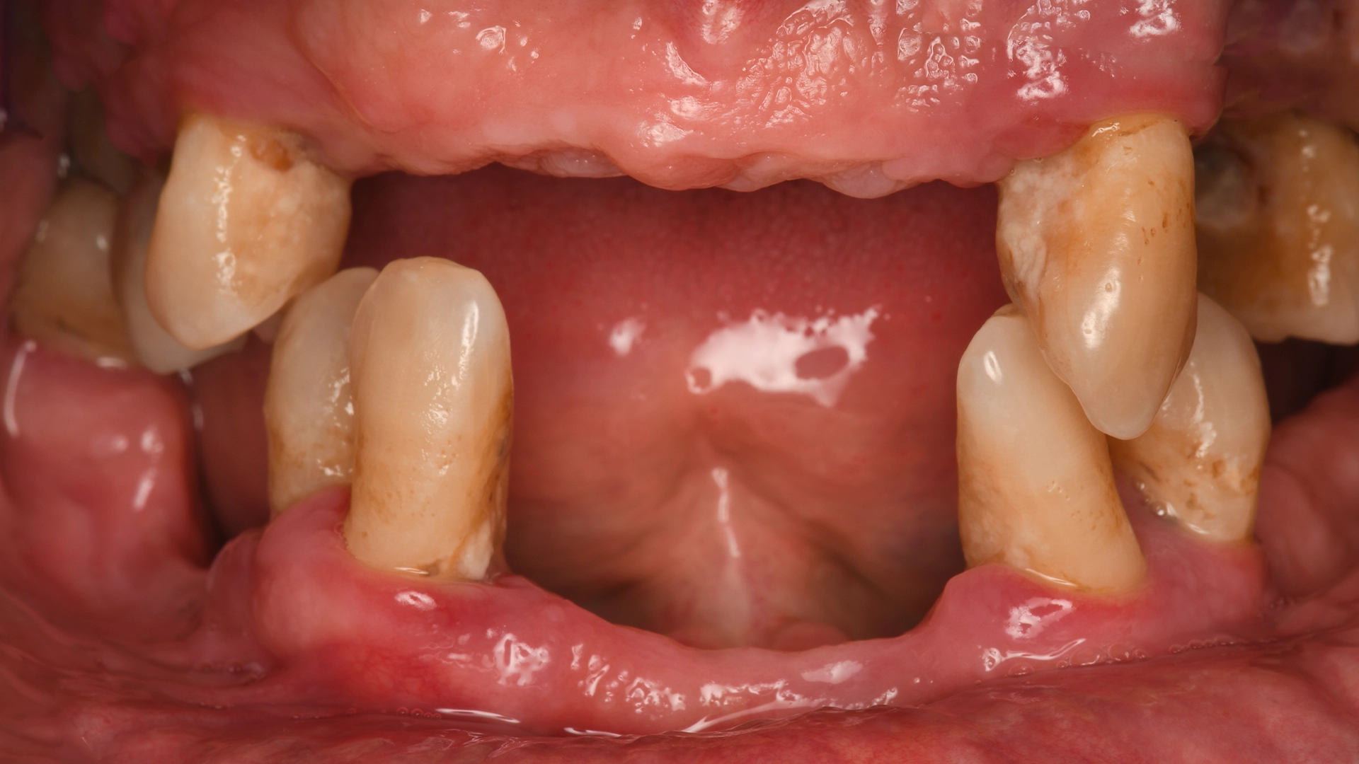 Before dental implant – teeth needing implant evaluation