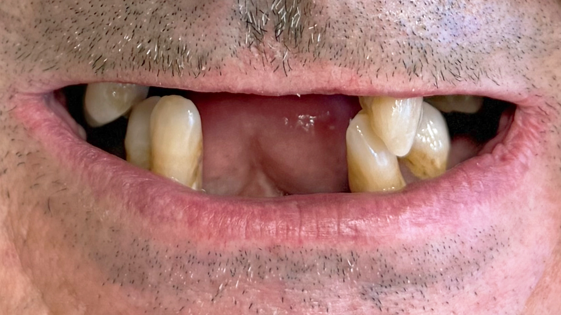 Before dental implant – missing or damaged teeth