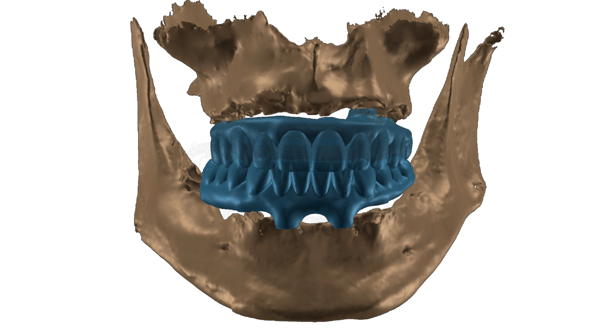 Planification numérique pour implant dentaire chez VIDENT Anvers