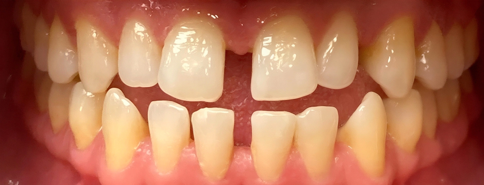Before orthodontic treatment – misaligned teeth