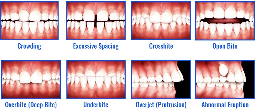 Common dental problems treated with aligners and braces at VIDENT Antwerp