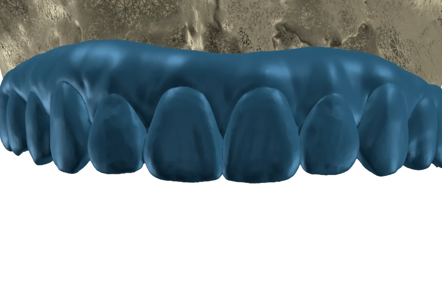 Дигитално планиране на импланти – VIDENT