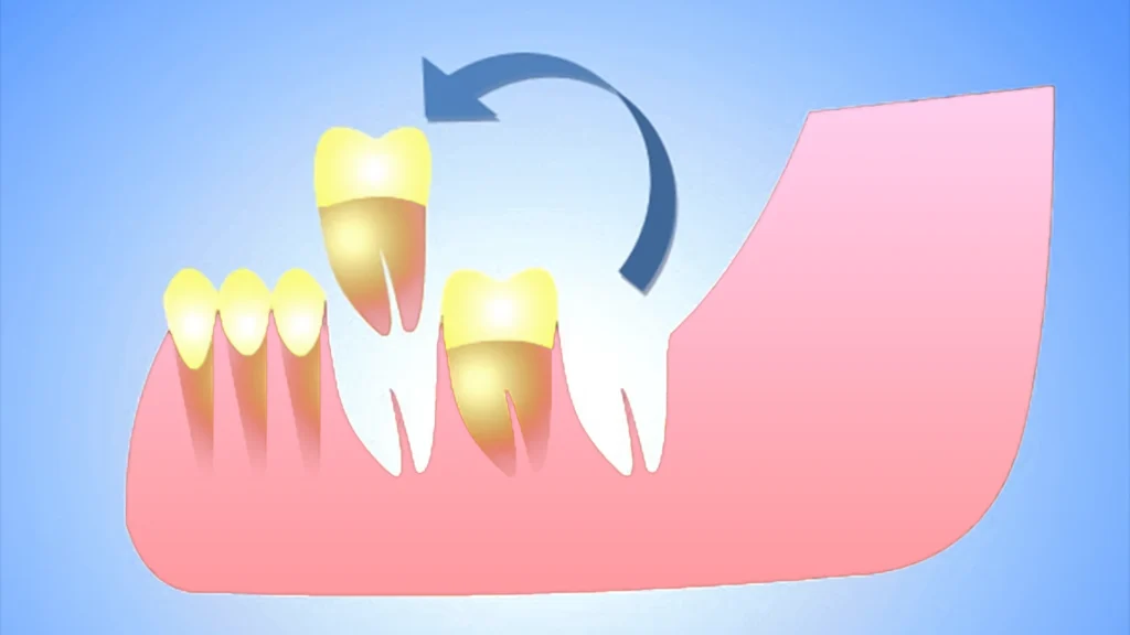 Autotransplantation in Antwerp