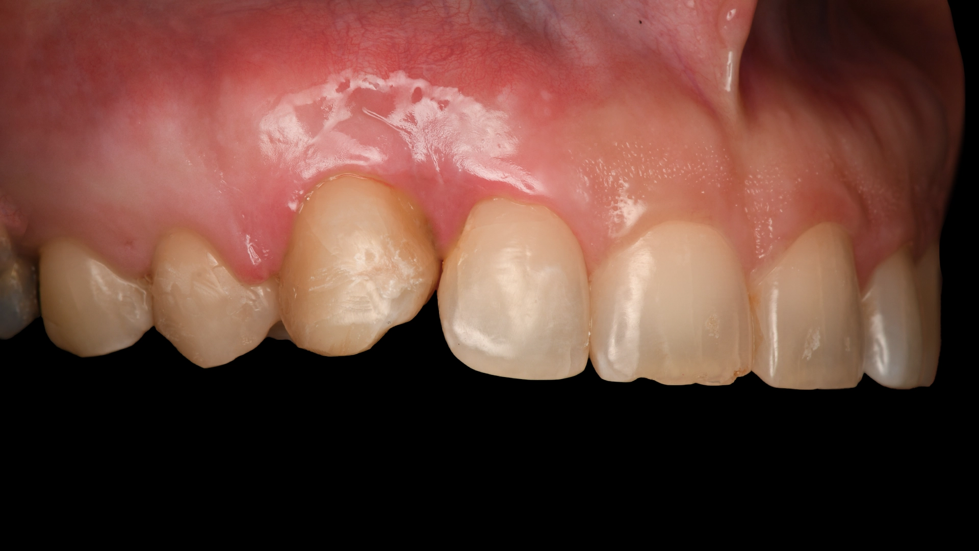 Autotransplantation after