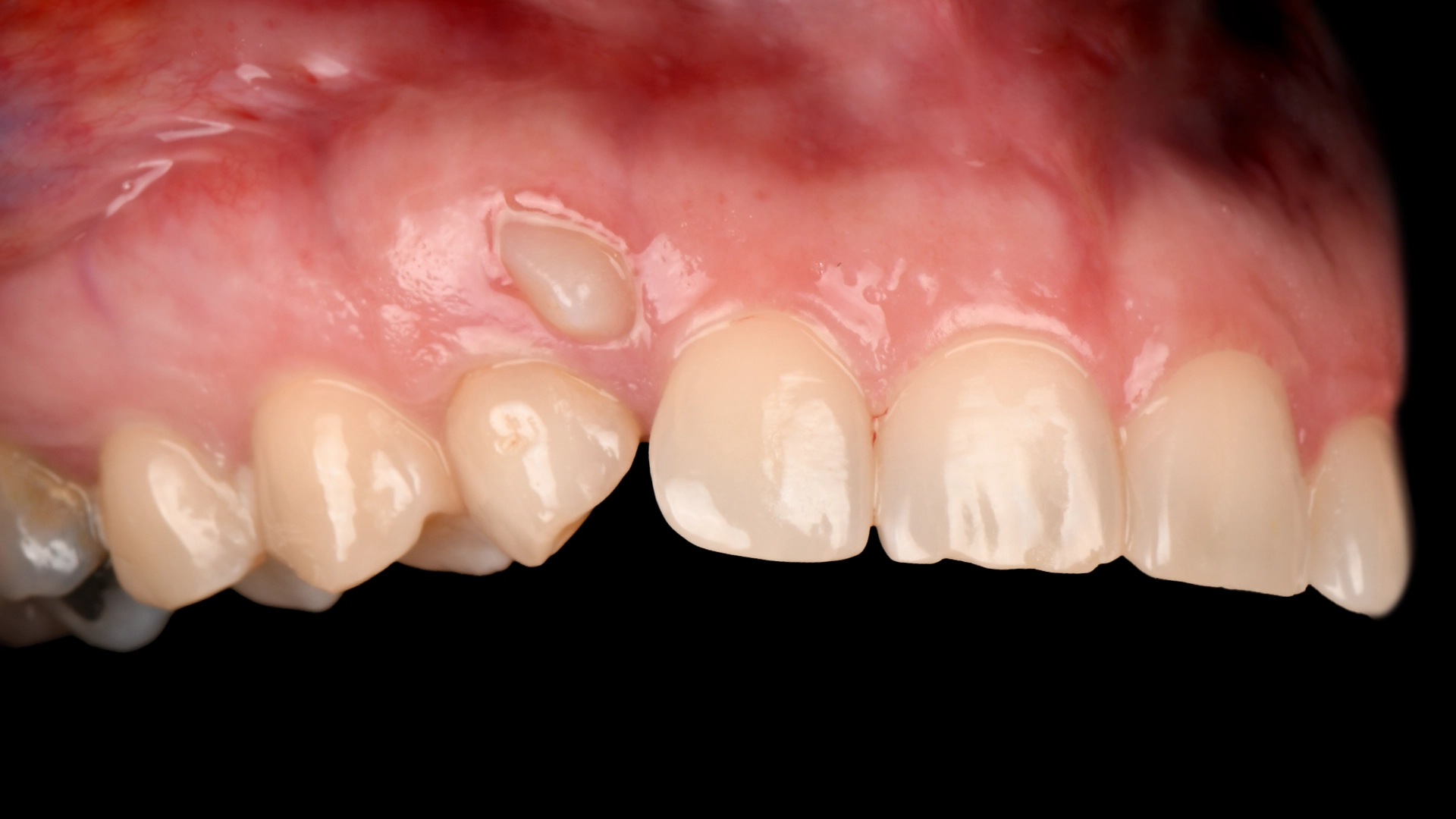 Autotransplantation before