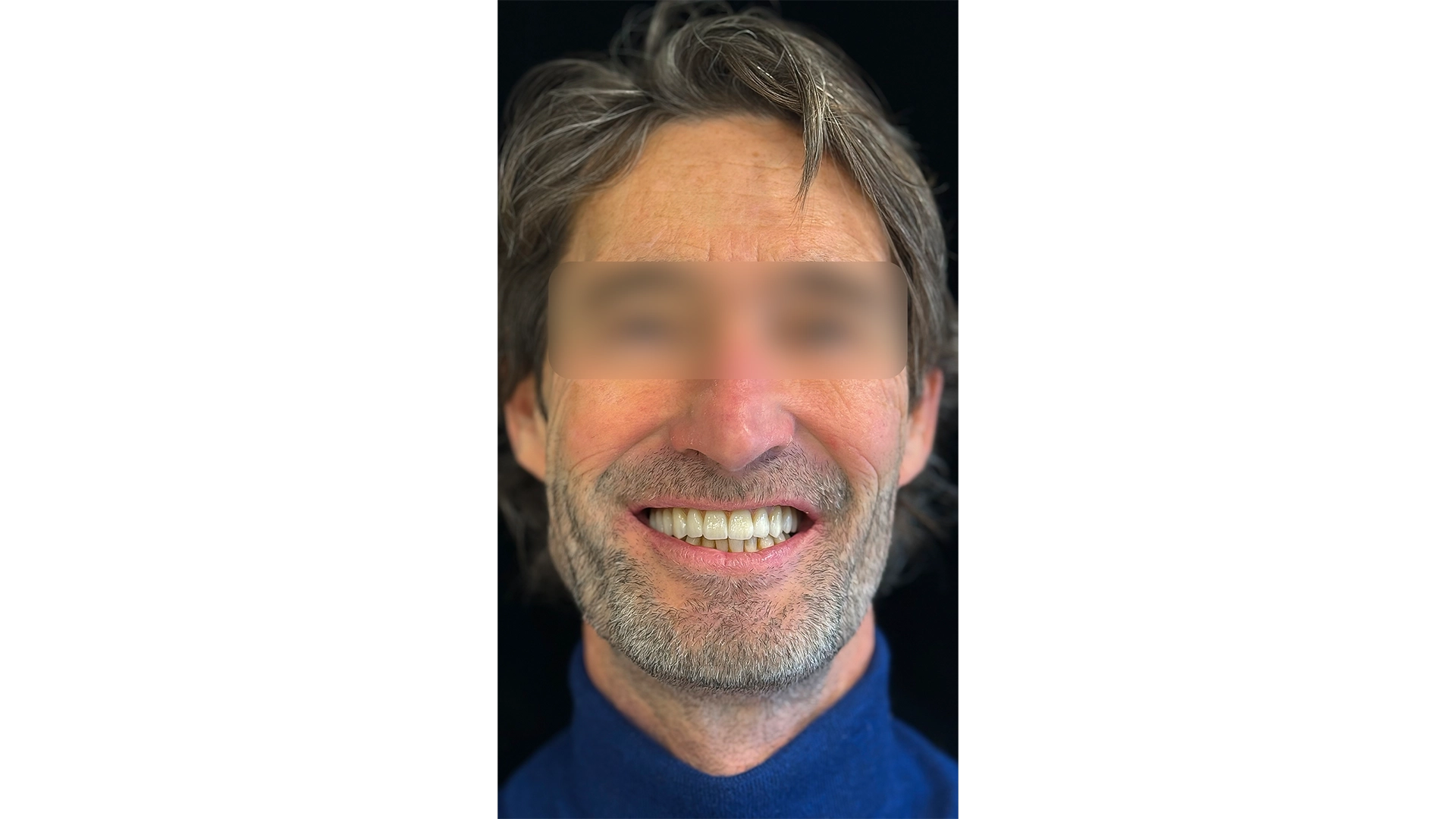 Patient smile result at VIDENT Antwerp after implant treatment