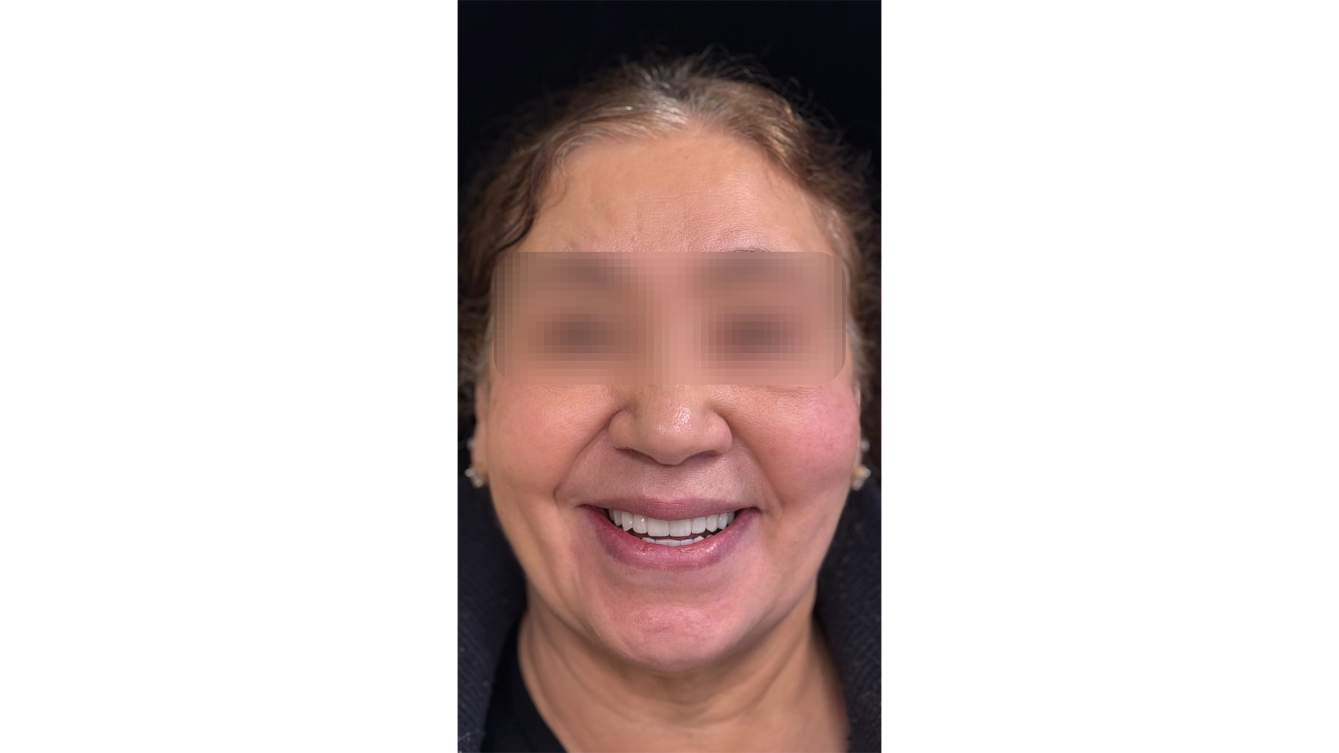 Voor- en na-resultaat orthodontische behandeling VIDENT