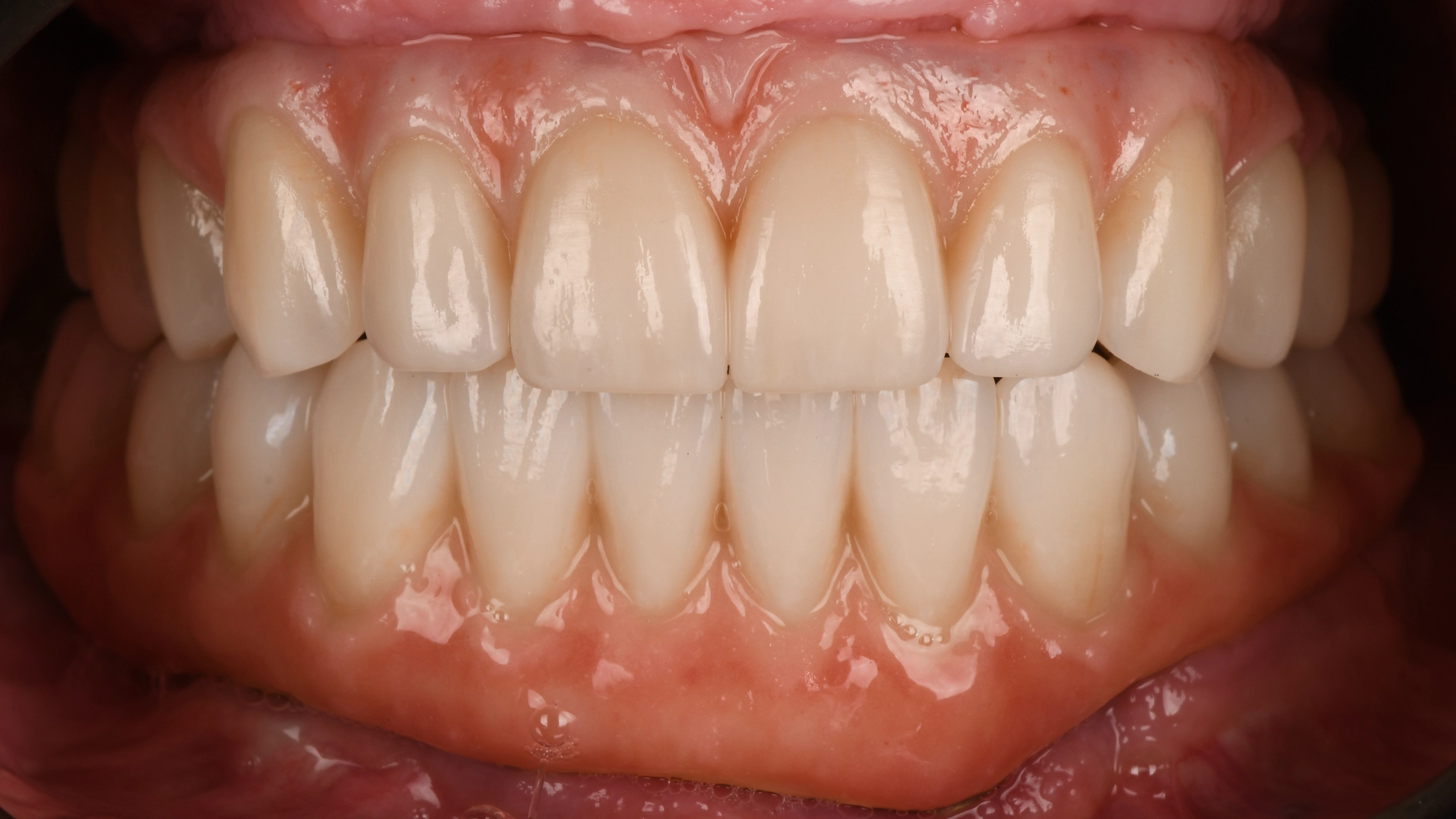 Resultaat van digital smile design behandeling
