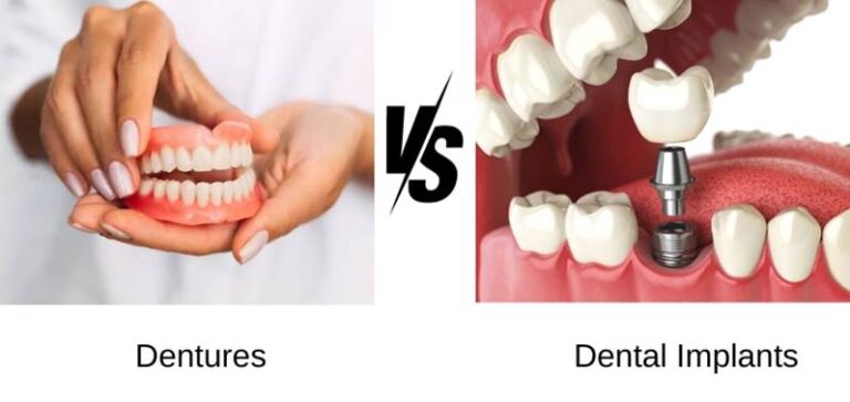 dental implants vs dentures